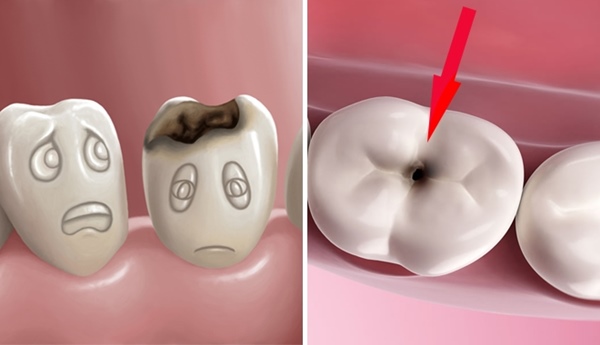 Cảnh báo sâu răng có thể nguy hiểm đến tính mạng