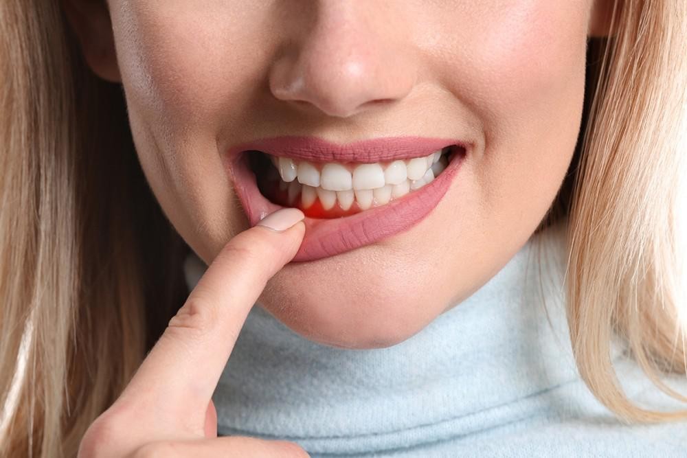 Chảy máu chân răng khi đánh răng? Nguyên nhân và cách phòng tránh.