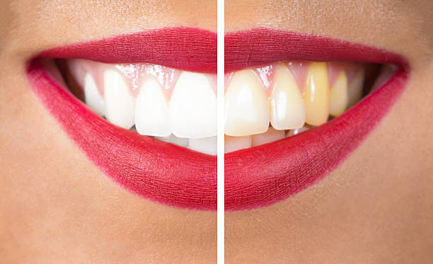 Tại sao răng chuyển sang màu vàng và cách khắc phục